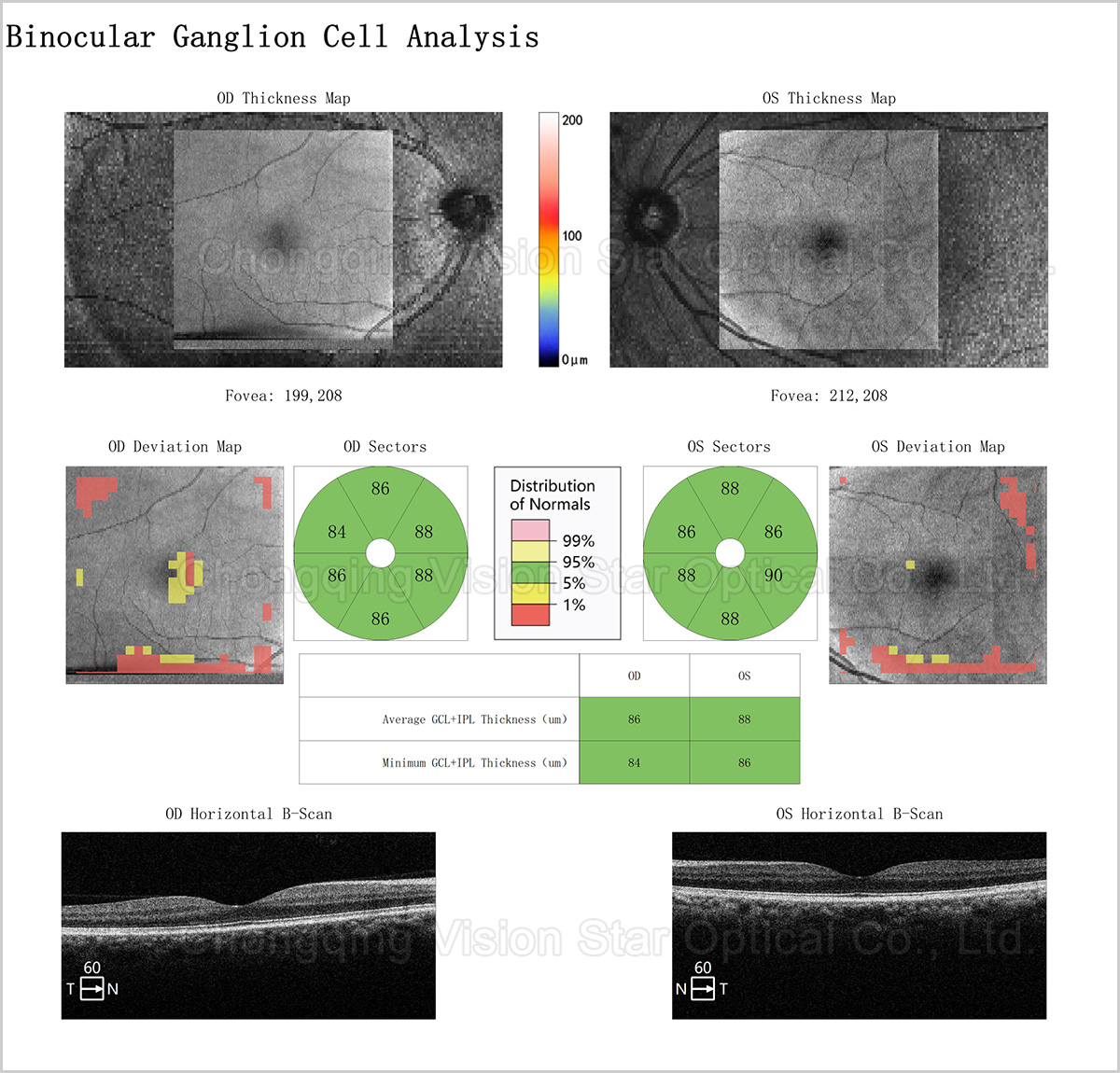 Binocular Ganglion Cell Analysis