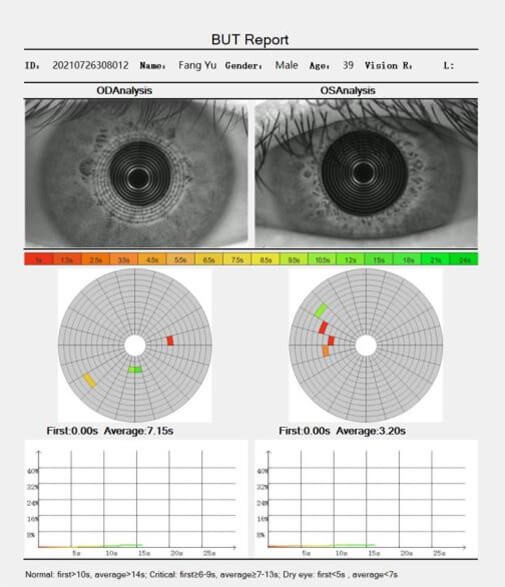 DE-5 Dry Eye Analyzer