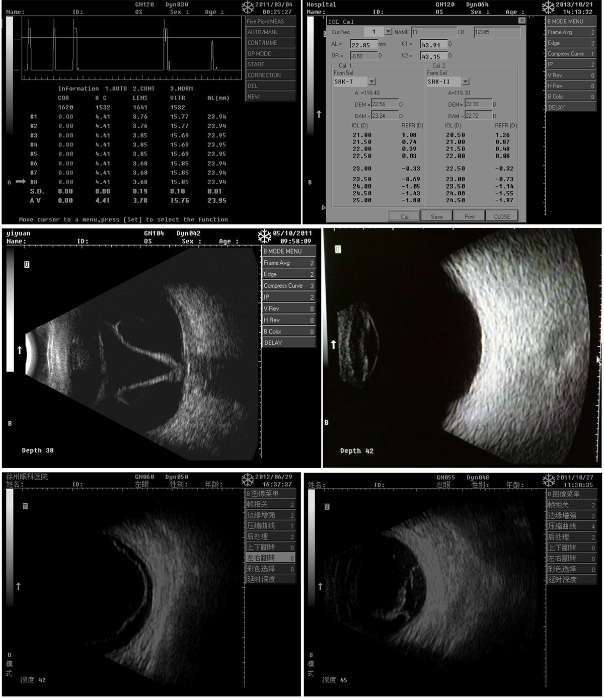 ODU-5 Ophthalmic A and B Scan