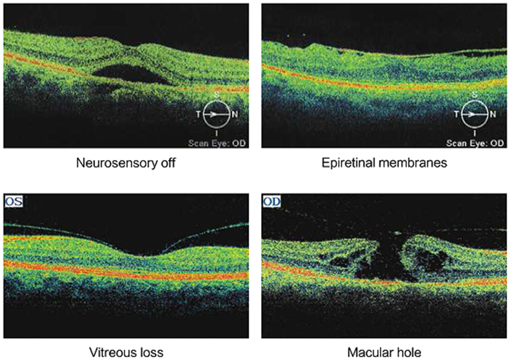 OSE-2000 OCT Optical Coherence Tomography